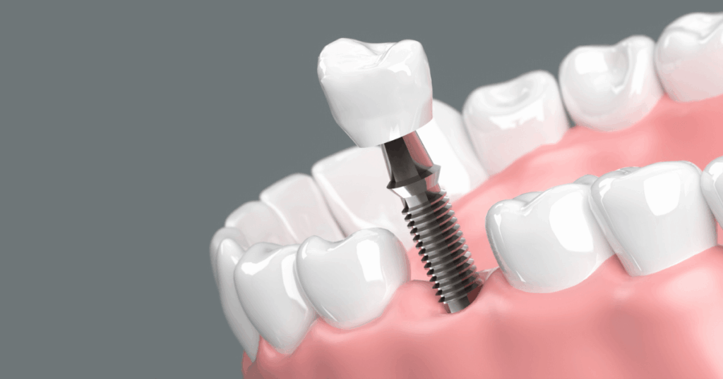 抜歯後の治療法として用いられるインプラントの構造を示したイメージ画像