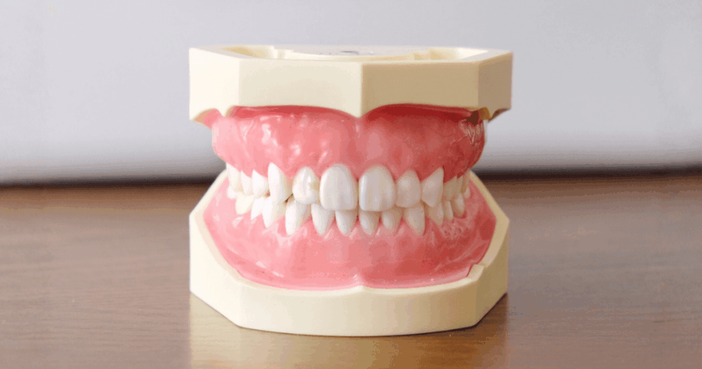 歯茎の腫れや膿が起こる原因を説明するための歯と歯茎の模型画像