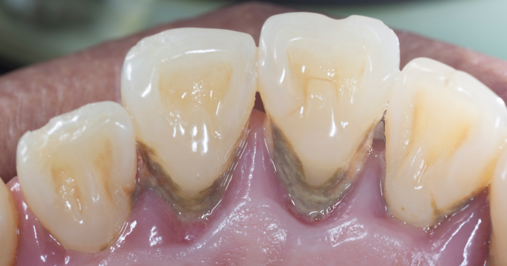 2. 糖尿病と歯周病の深い関係