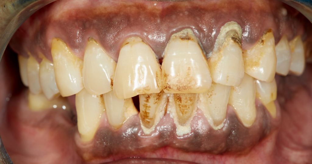 治療後の隙間に食べかすが詰まりやすい理由と対処ポイント