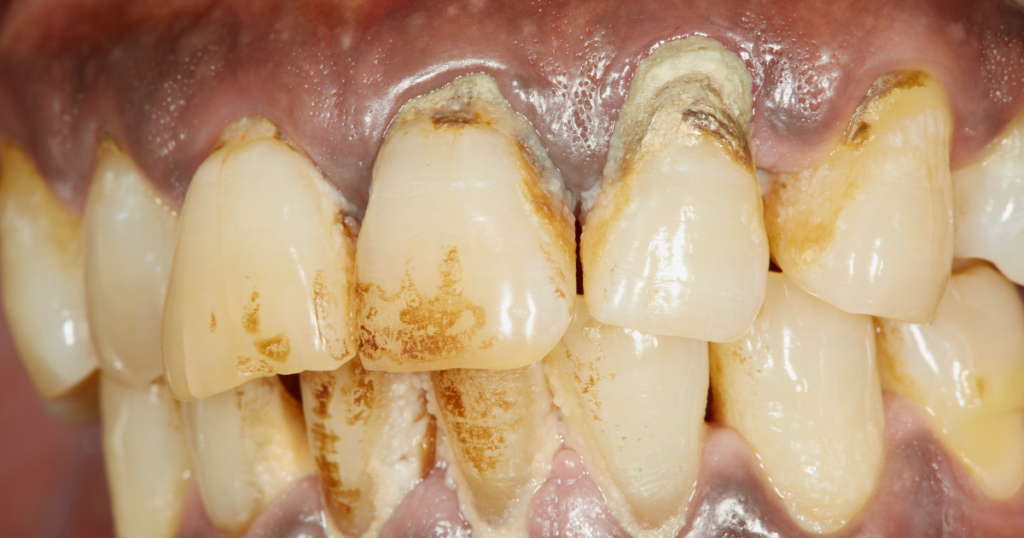 1. 喫煙は最大のリスクファクター