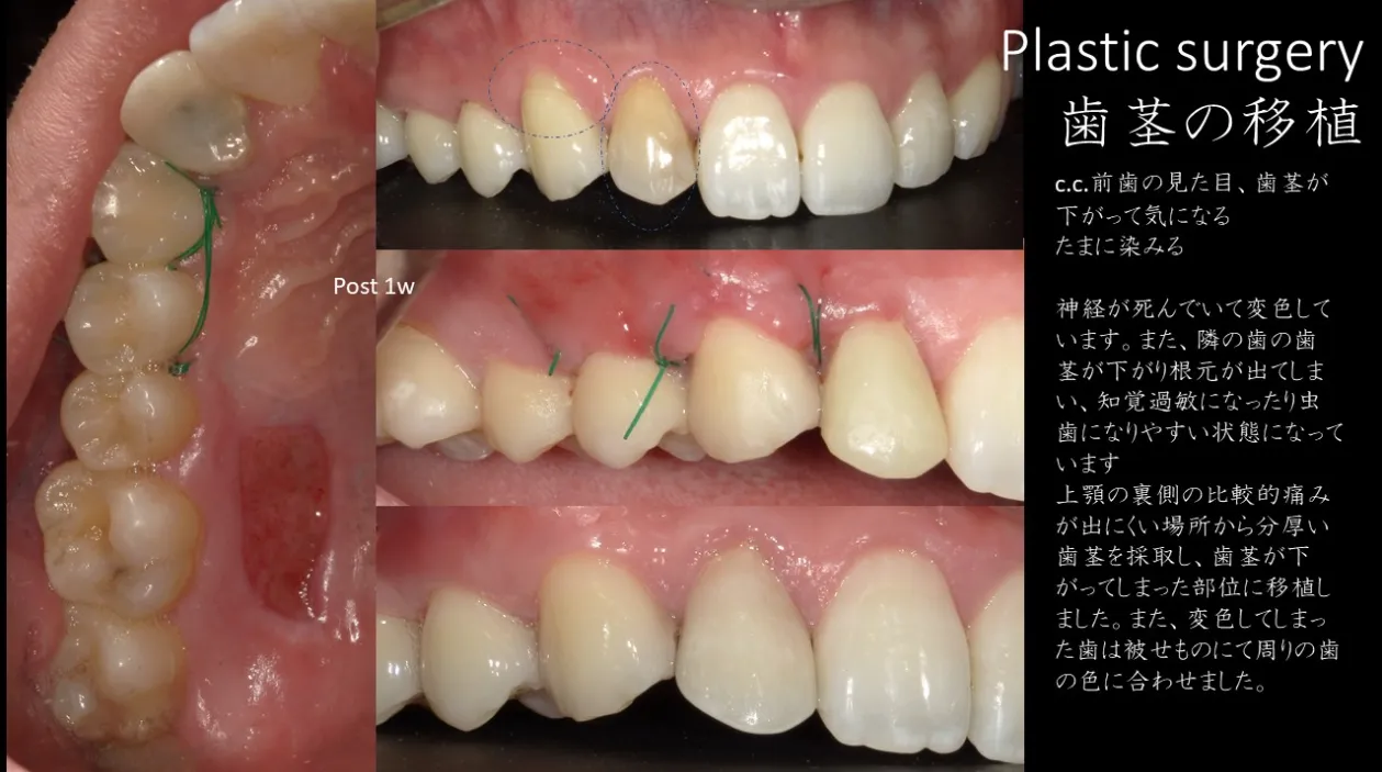 審美歯科治療の事例紹介