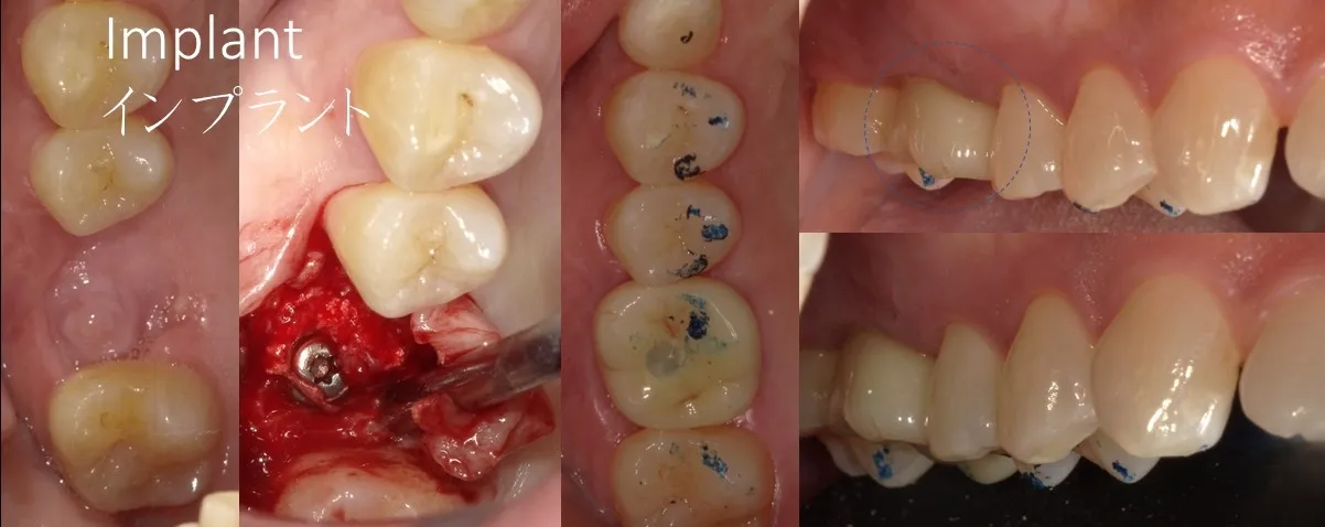 インプラント治療の事例紹介