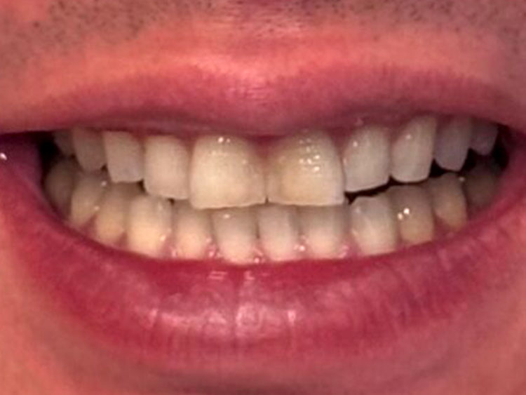 BEFORE