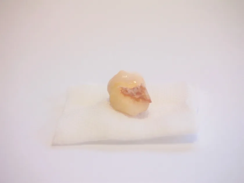 親知らずは何本まで生える？