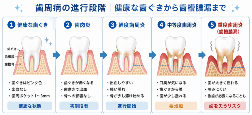 歯槽膿漏と歯周病の進行